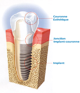 Implant-dentaire